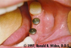 3 Mo. Before Abutment - ITI