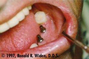 After Abutment - ITI